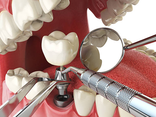 Best Emergency Dental Extractions in Riverdale Park, CA
